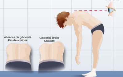 Scoliose de l’enfant, les parents peuvent facilement la dépister. La scoliose et ses symptômes.