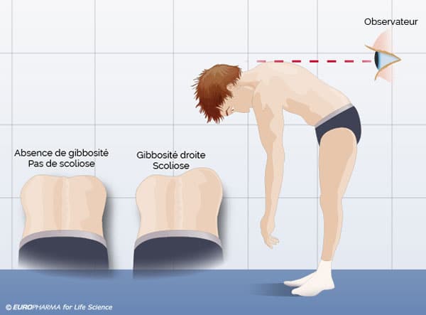Scoliose de l’enfant, les parents peuvent facilement la dépister. La scoliose et ses symptômes.
