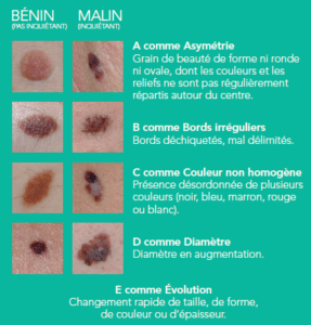 Tableau récapitulatif de la règle ABCDE, auto-examen cancer de la peau, mélanome. 
