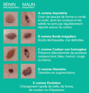 Tableau récapitulatif de la règle ABCDE, auto-examen du cancer de la peau, mélanome. 