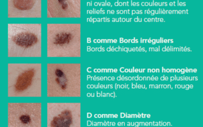 Comment détecte-t-on un cancer de la peau ? La « règle ABCDE »