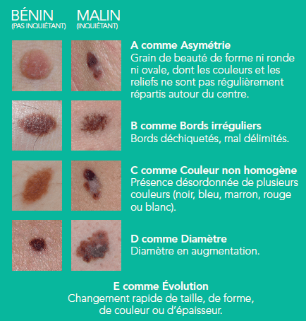 Comment détecte-t-on un cancer de la peau ? La « règle ABCDE »