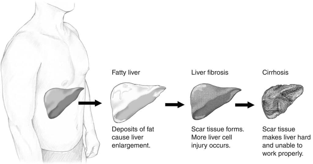 Évolution de la stéatose hépatique vers la fibrose et la cirrhose