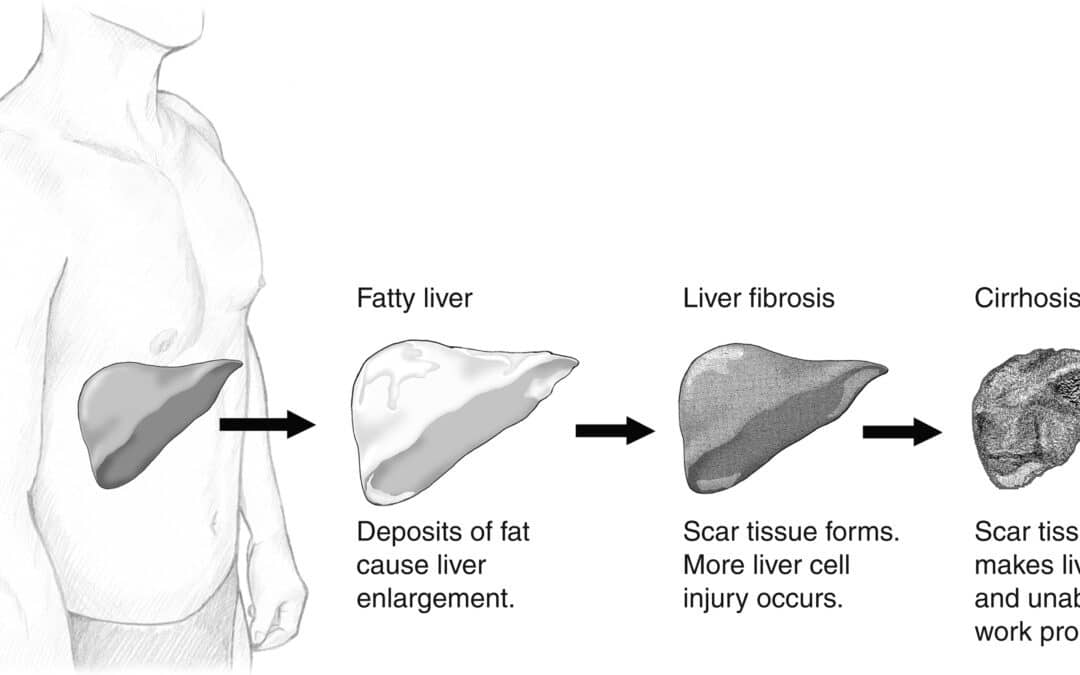 Stéatose hépatique : trois habitudes simples peuvent-elles vraiment aider le foie ?