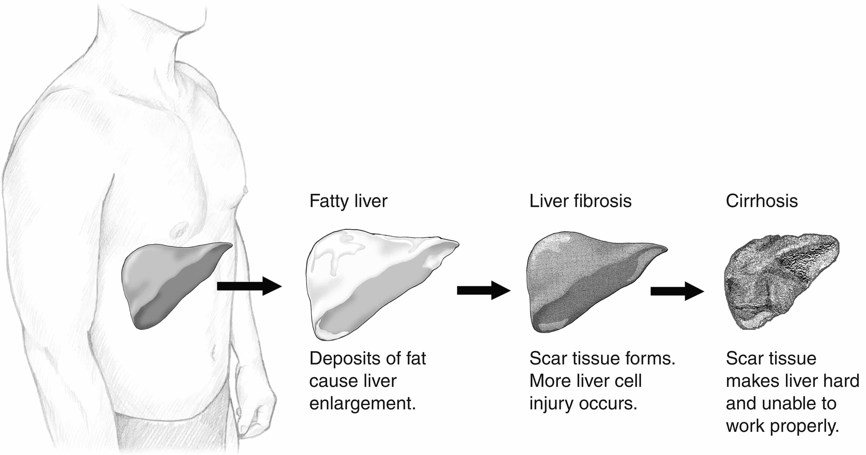 Évolution de la stéatose hépatique vers la fibrose et la cirrhose
